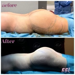 Before and after Brazilian Butt Lift results at Db'est Clinic – enhanced buttock contour