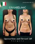 نتائج قبل وبعد شفط الدهون ورفع الثدي في Grand Clinic، تحسين شكل الجسم