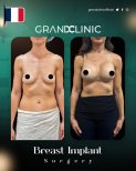 نتائج قبل وبعد تكبير الثدي في Grand Clinic – تحسين شكل وحجم الثدي