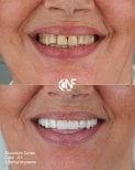 Before and after zirconium crowns and dental implants result at Nifa Dent International clinic