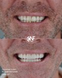 Before and after zirconium crown results at Nifa Dent International, improved smile aesthetics