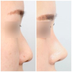 before-after photo revision-rhinoplasty
