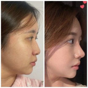 before-after photo revision-rhinoplasty