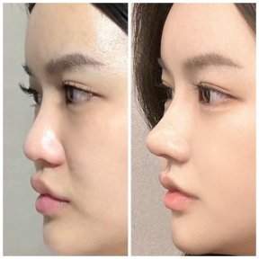 before-after photo revision-rhinoplasty