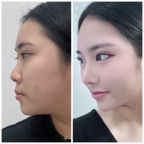 before-after photo revision-rhinoplasty