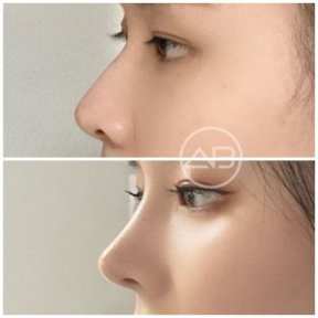 before-after photo revision-rhinoplasty