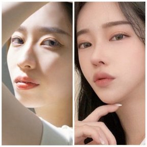 before-after photo revision-rhinoplasty