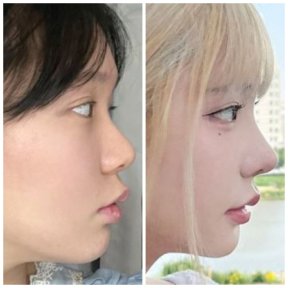 before-after photo revision-rhinoplasty