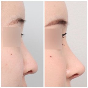 before-after photo revision-rhinoplasty