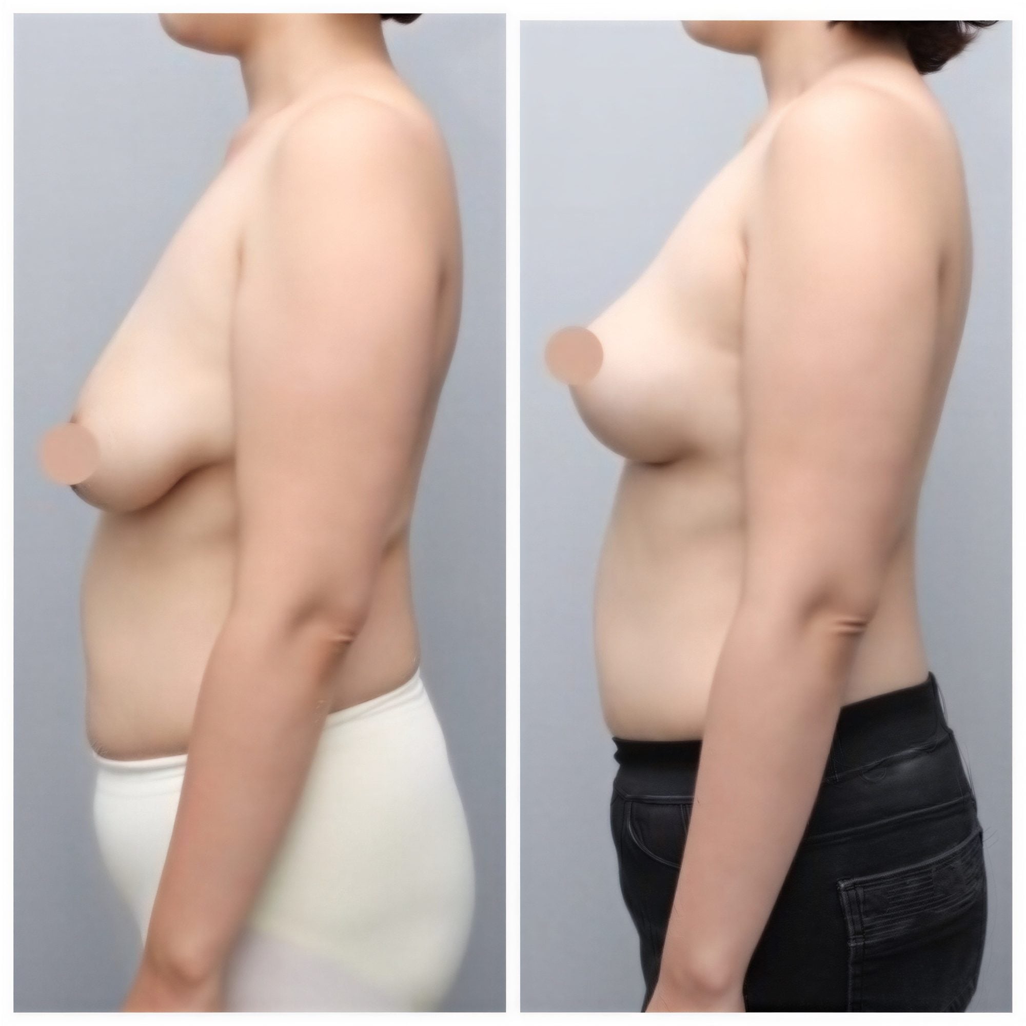 قبل وبعد تكبير ورفع الثدي في AB Plastic Surgery – تحسين شكل الثدي النهائي