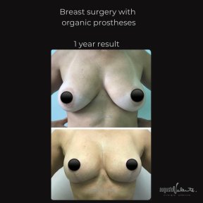 Breast augmentation with organic prostheses, 1 year result – improved breast shape