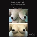 Breast augmentation with organic prostheses, 1 year result – improved breast shape