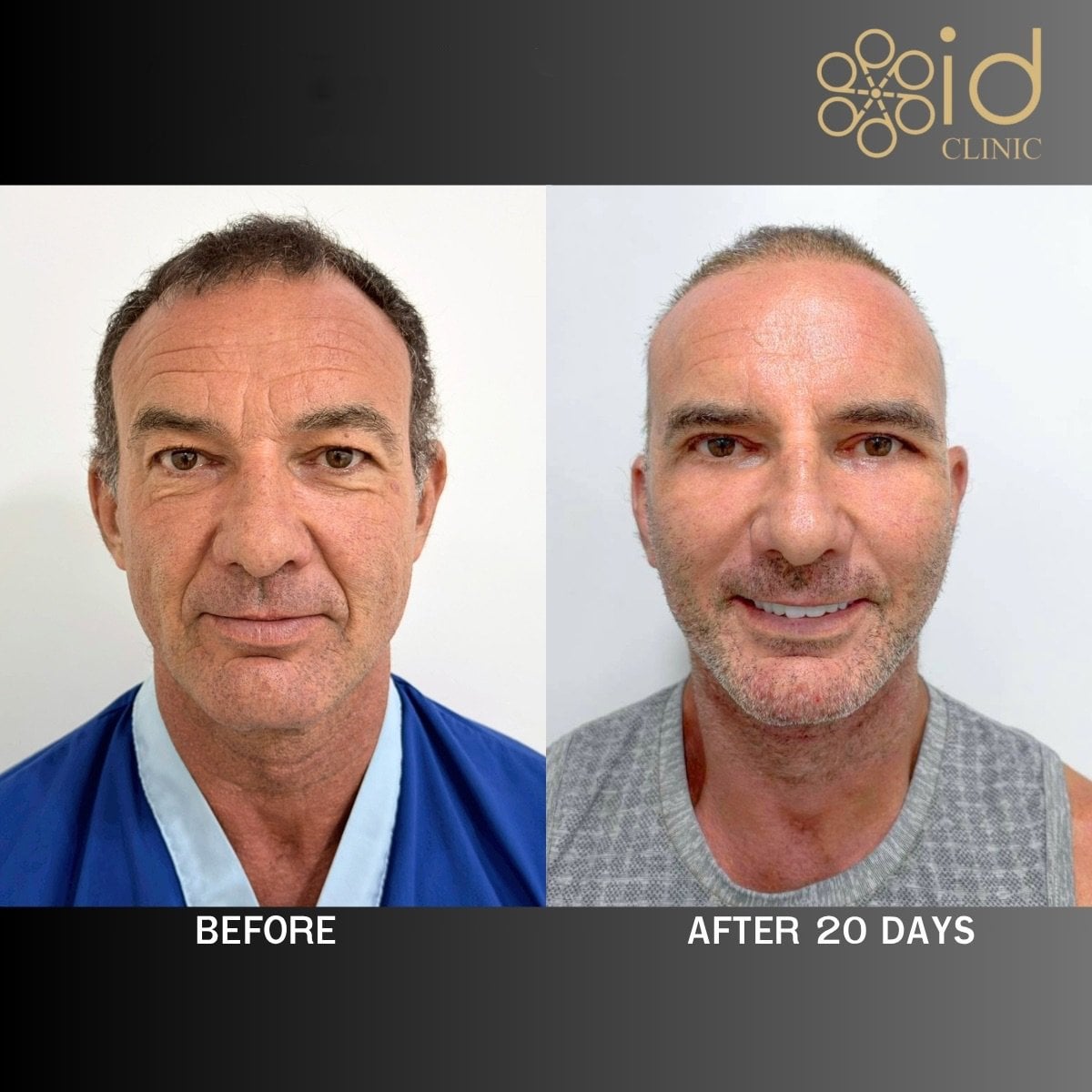 نتائج قبل وبعد شد الوجه العميق في ID Clinic Bangkok، تجديد واضح للوجه
