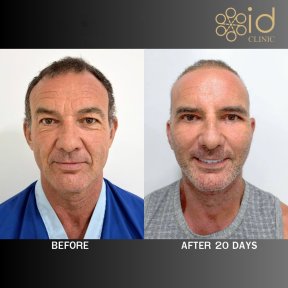 before-after photo glubokaya-podtyazhka-lica-deep-plane-facelift