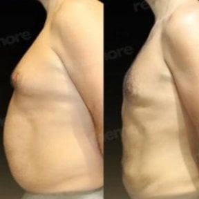 Before and after tummy tuck results at Memorial Bahçelievler Hospital, improved abdomen contour