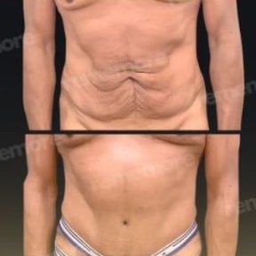 Before and after tummy tuck results at Memorial Bahçelievler Hospital, improved abdominal contour