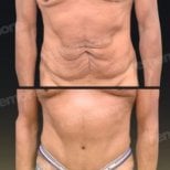Before and after tummy tuck results at Memorial Bahçelievler Hospital, improved abdominal contour