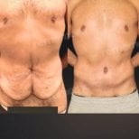 Before and after tummy tuck results at Memorial Bahçelievler Hospital, improved abdomen contour