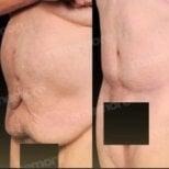 Before and after tummy tuck results at Memorial Bahçelievler Hospital, improved abdomen contour