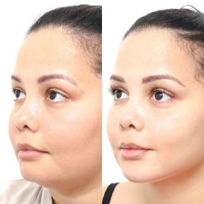 before-after photo buccal-fat-extraction