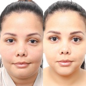 before-after photo buccal-fat-extraction