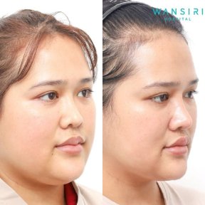 before-after photo buccal-fat-extraction