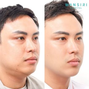 before-after photo buccal-fat-extraction