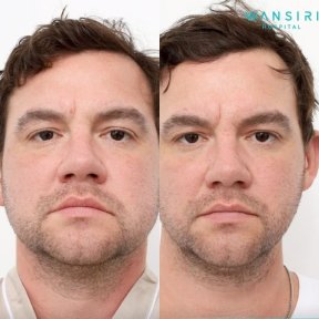before-after photo buccal-fat-extraction