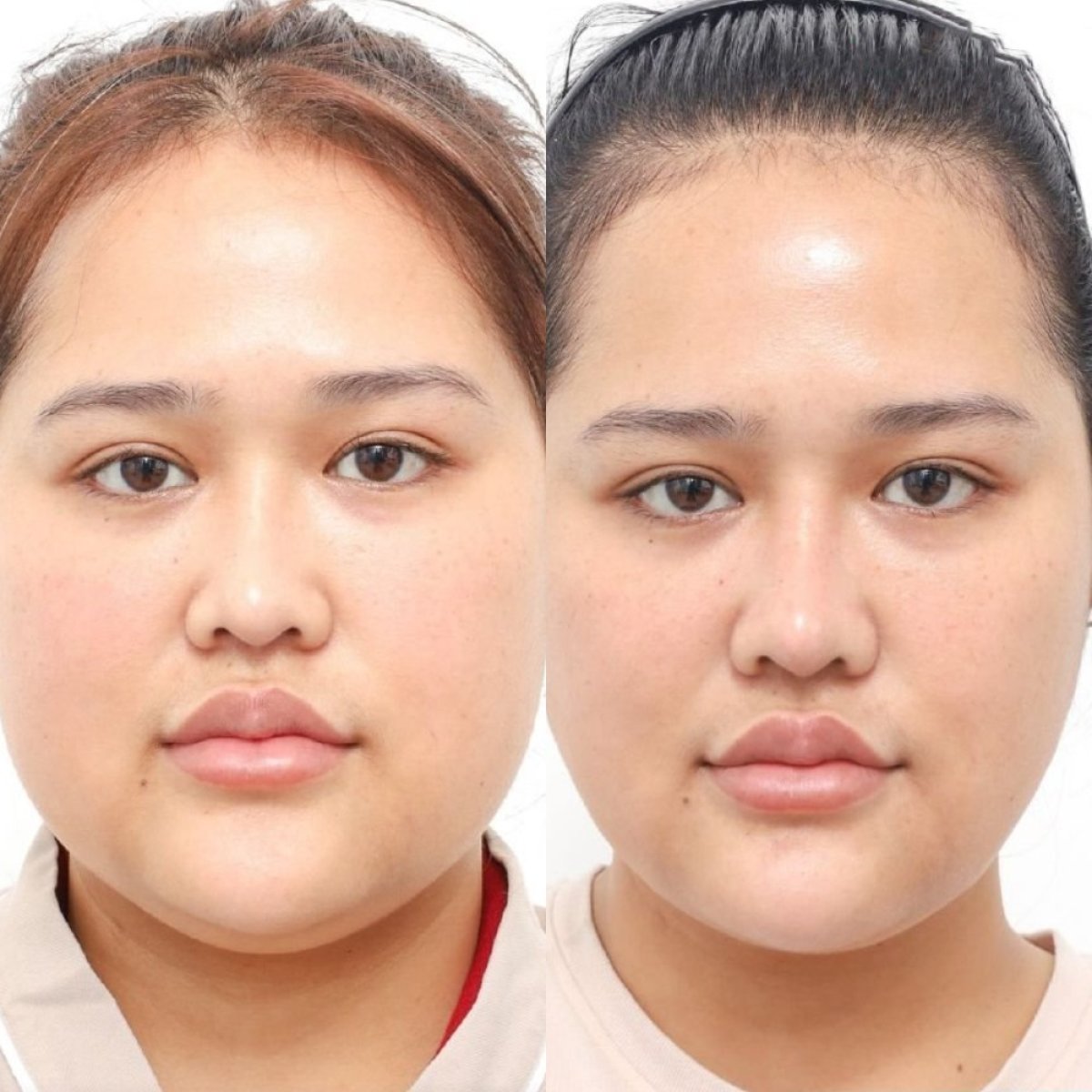 Antes y después de extracción de grasa bucal en Wansiri Hospital, mejillas más delgadas
