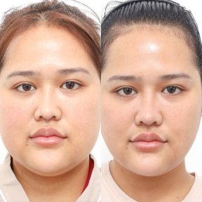 before-after photo buccal-fat-extraction