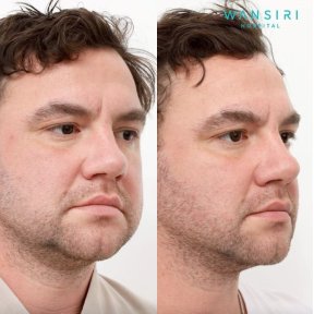 before-after photo buccal-fat-extraction
