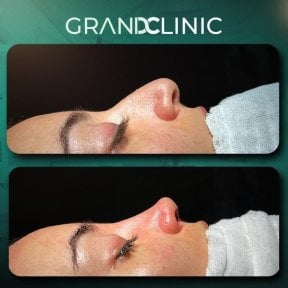 Before and after rhinoplasty result at Grand Clinic, nose reshaping with refined contour