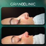 نتيجة عملية تجميل الأنف قبل وبعد في Grand Clinic، إعادة تشكيل الأنف