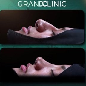 Before and after rhinoplasty results at Grand Clinic, improved nose shape and profile