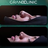 نتائج تجميل الأنف قبل وبعد في Grand Clinic، تحسين شكل ومظهر الأنف