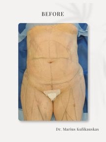 before-after photo abdominoplasty