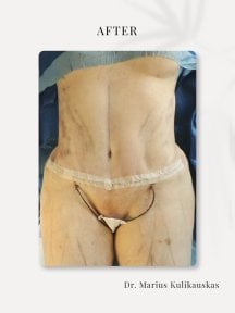 before-after photo abdominoplasty