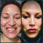 Before and after dental veneers at Grand Clinic, smile transformation and whiter teeth result