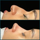 نتائج عملية تجميل الأنف قبل وبعد في Grand Clinic، إعادة تشكيل الأنف بشكل طبيعي