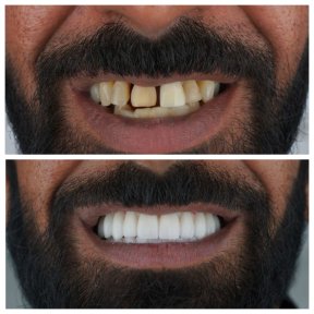 before-after photo zirconia-crown-installation