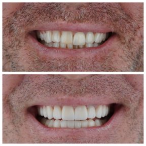 before-after photo zirconia-crown-installation