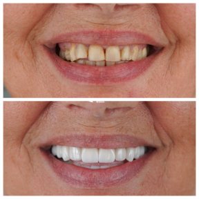 before-after photo zirconia-crown-installation