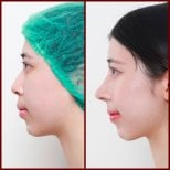 Before and after closed rhinoplasty result at DGB Clinic, improved nose profile and contour