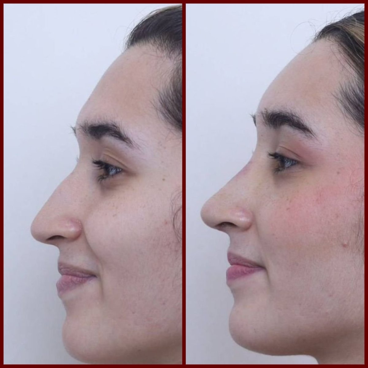 Resultados de rinoplastia cerrada antes y después en DGB Clinic, perfil nasal mejorado