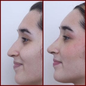 Closed rhinoplasty before and after results at DGB Clinic, improved nose profile and contour