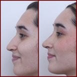 Closed rhinoplasty before and after results at DGB Clinic, improved nose profile and contour