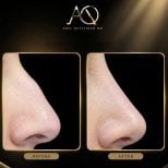 Resultados de rinoplastia antes y después en Adel Quttainah MD, mejora de la nariz