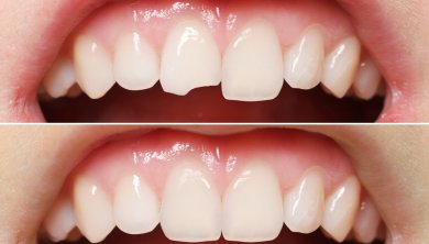 Resultados antes y después de coronas dentales: restauración de dientes frontales