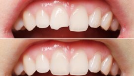 Resultados antes y después de coronas dentales: restauración de dientes frontales