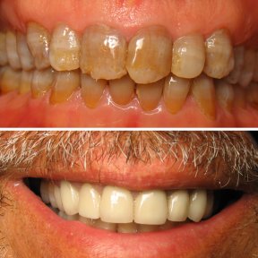 Resultados antes y después de la colocación de coronas dentales: sonrisa mejorada y dientes blancos